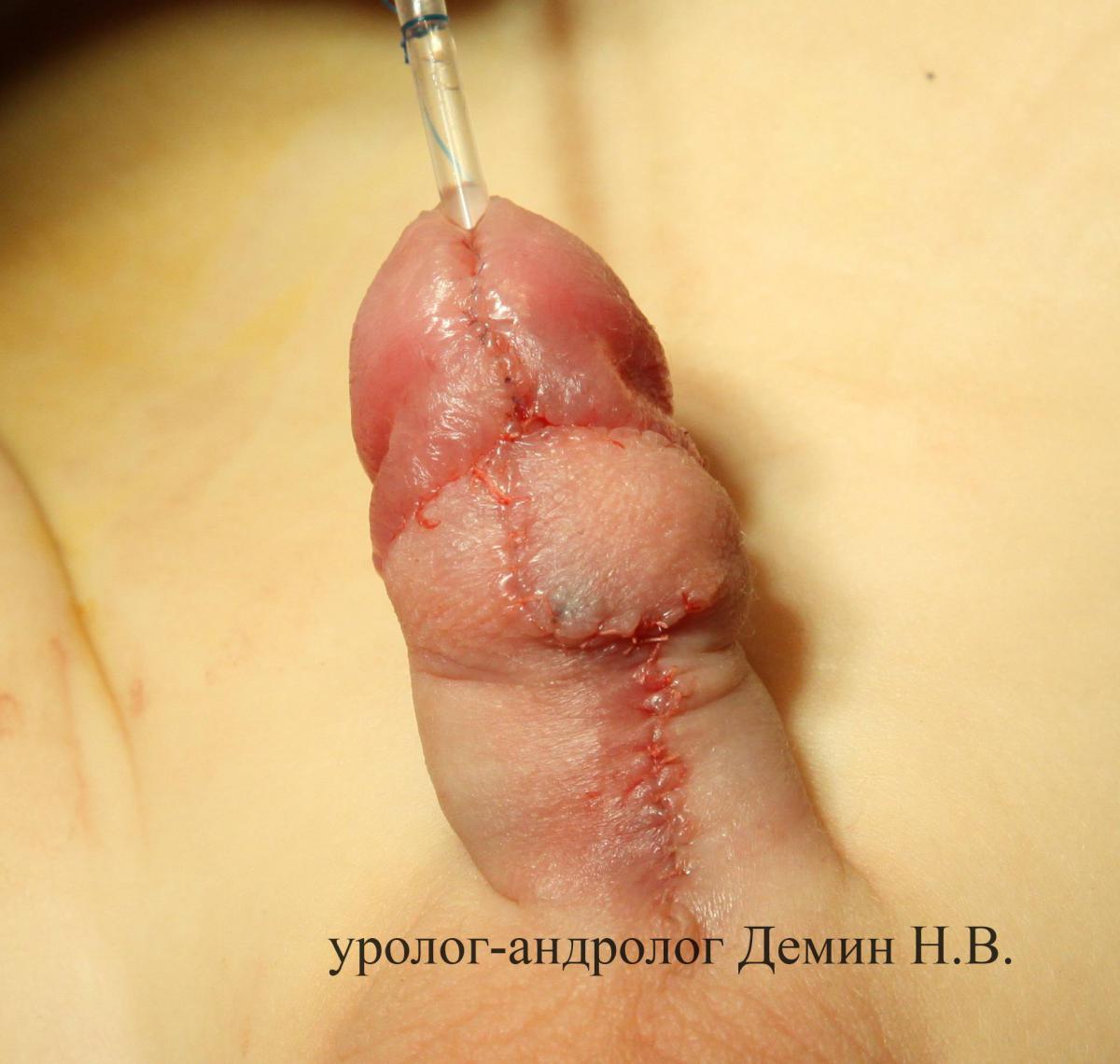 Стволовая гипоспадия, фото после операции